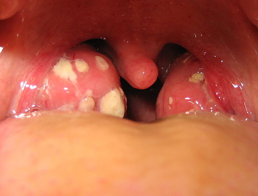 17.3.1 Tonsilitis