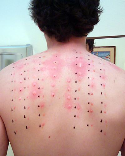 17.6.5 Allergy Tests