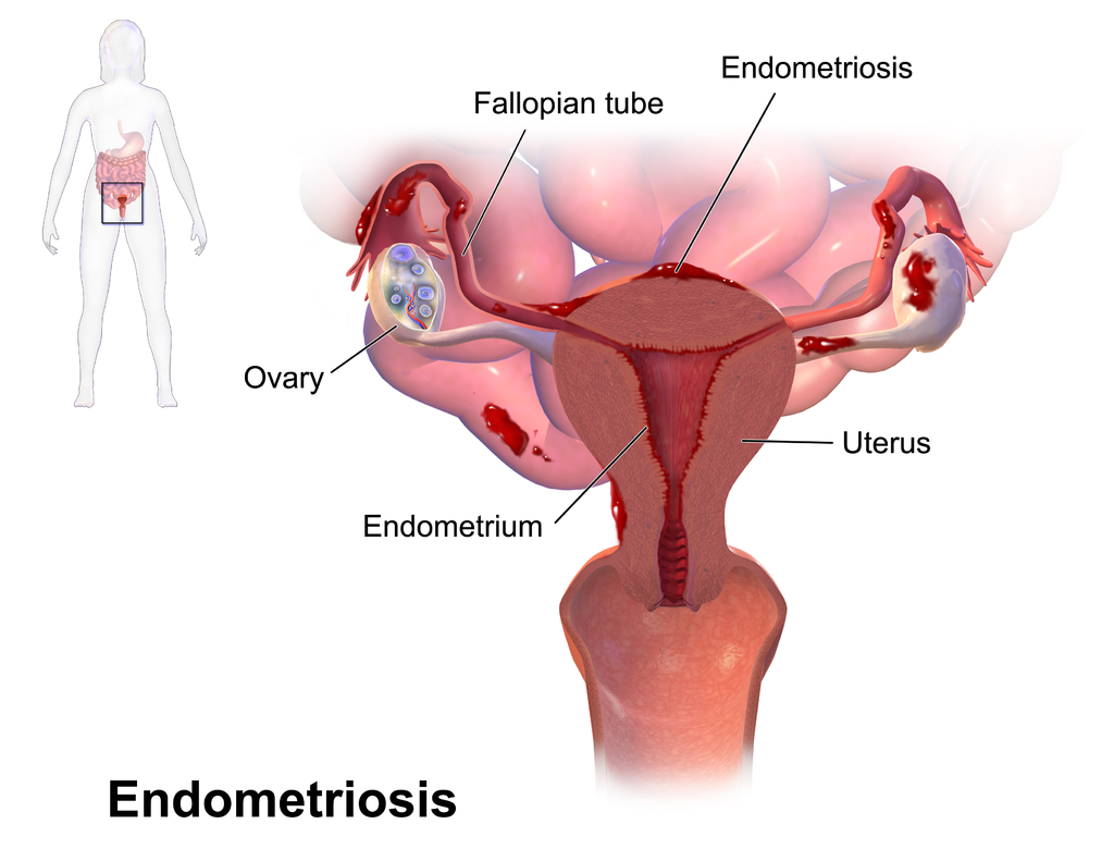 18.9.5 Endometriosis
