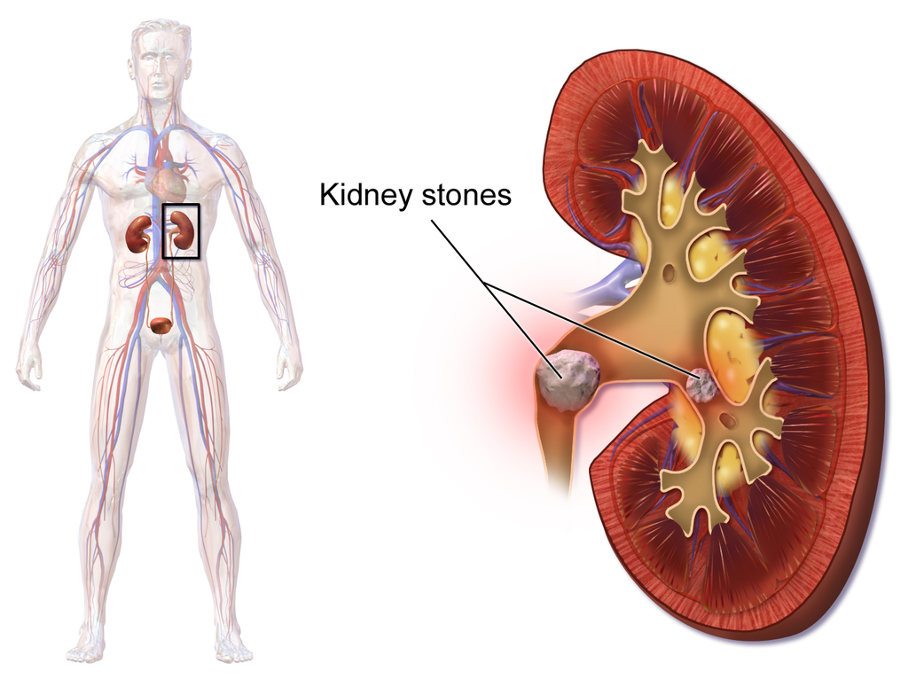 16.6.5 Kidney Stones