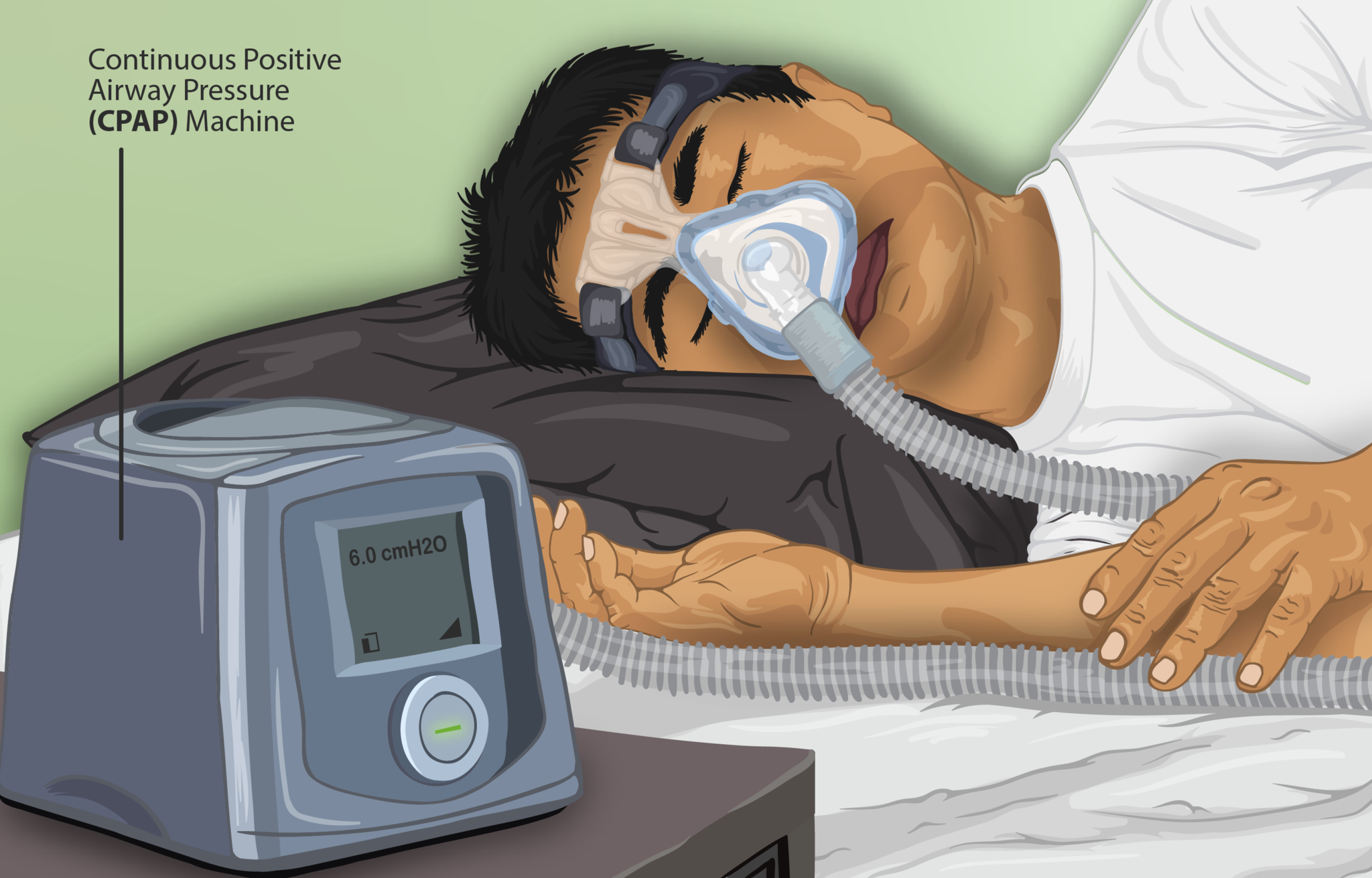 15.5.7 CPAP to Treat Sleep Apnea