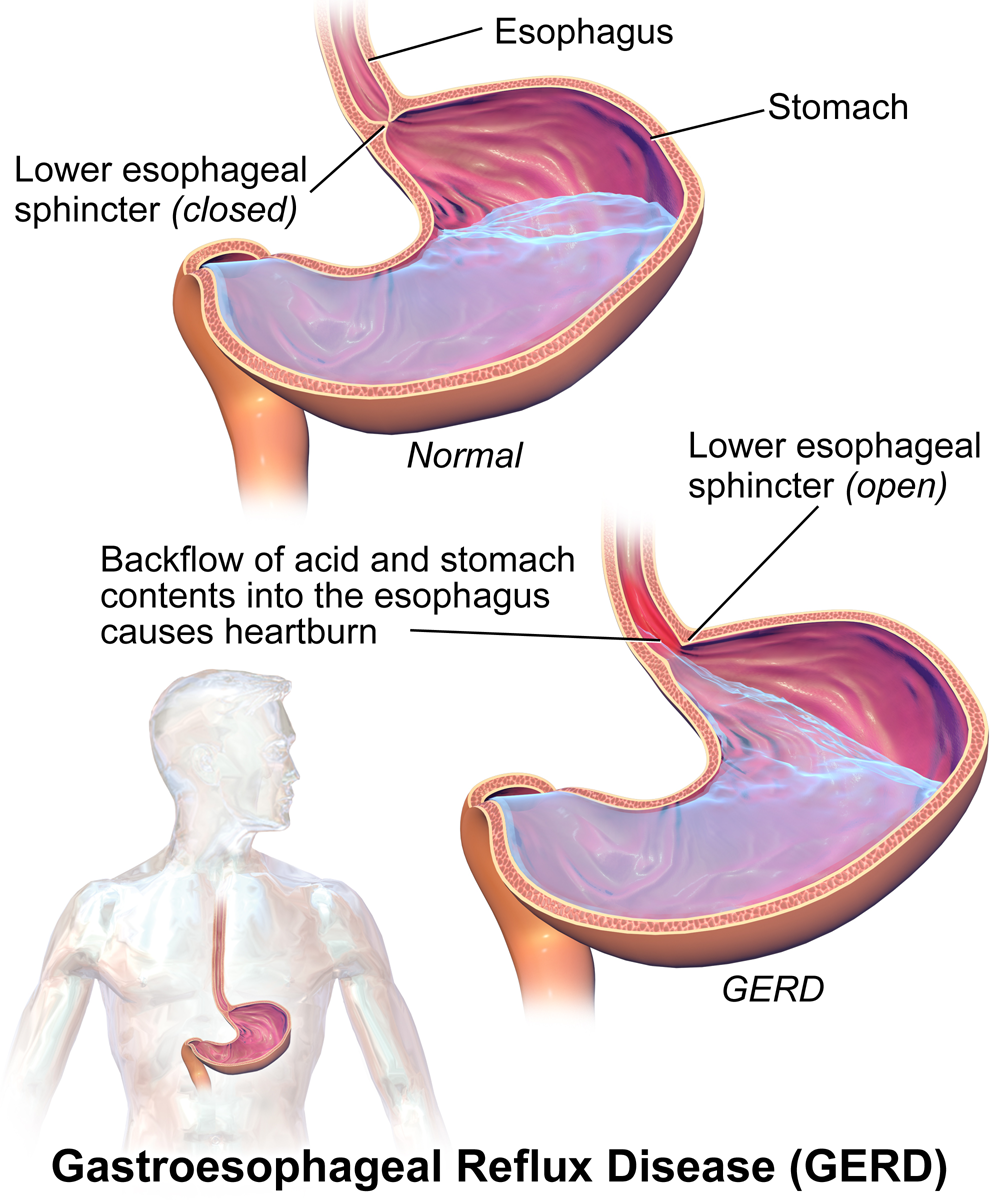 Image shows two diagrams of the stomach and esophagus. In the first diagram, the esophageal sphincter is tightly closed, preventing contents of the stomach from re-entering the esophagus. In the second diagram, the esophageal sphincter is relaxed, open, and the stomach contents are able to re-enter the esophagus.