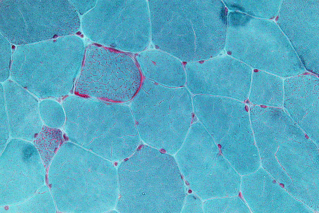 Image shows a micrograph of muscle tissue. Two of the cells contain large numbers of small red granules, which are diseased mitochondria.