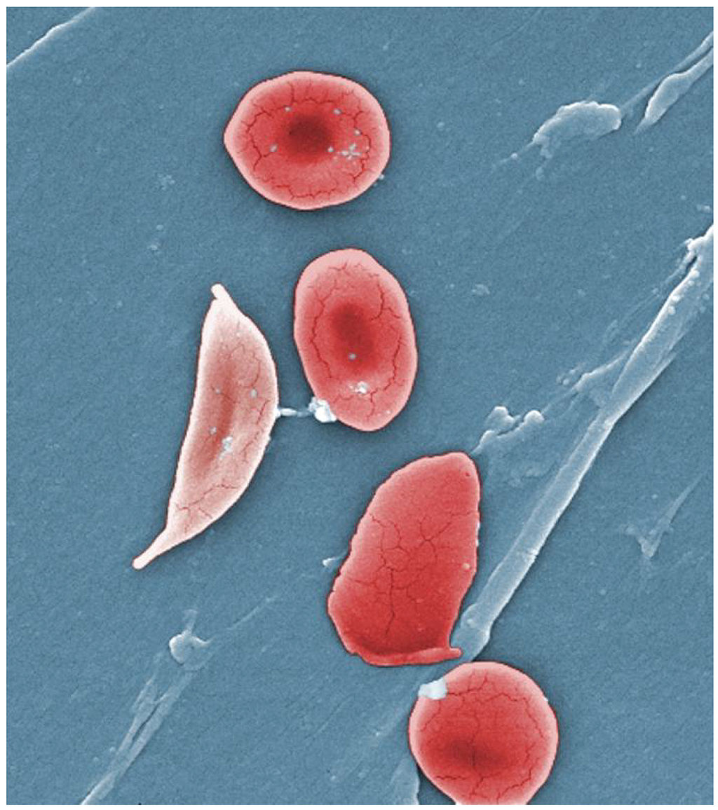 Image shows the difference in morphology between a sickle cell and a normal red blood cell.