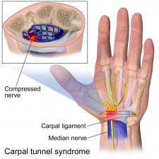 12.6 Disorders of the Muscular System – Human Biology